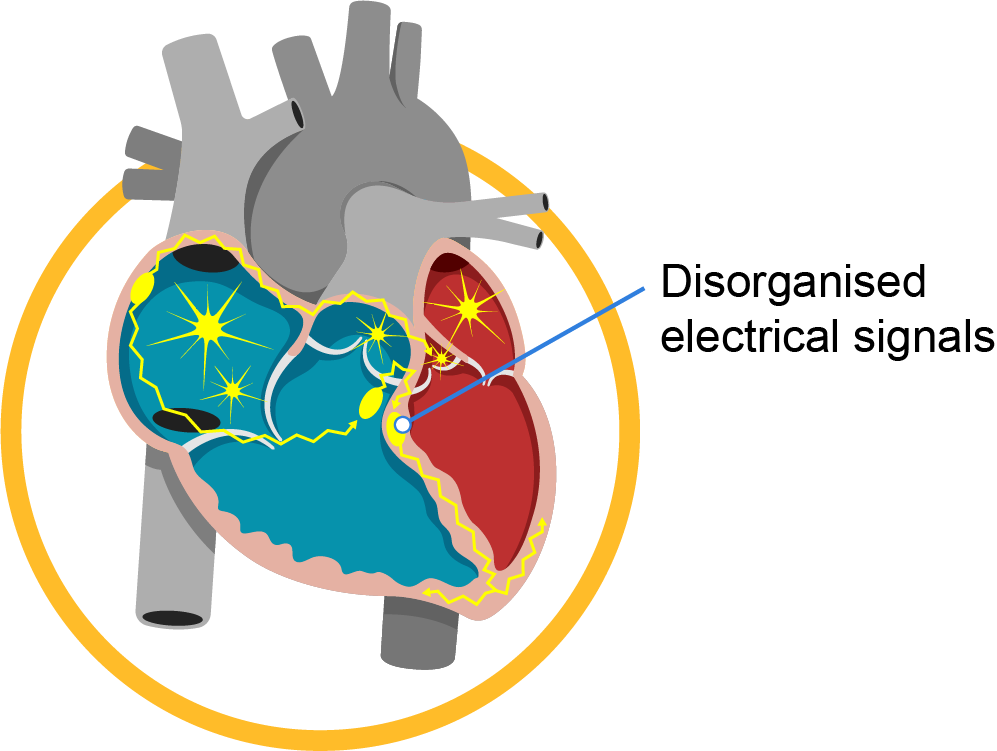 abnormal_heart_rhythm_infobanner_1