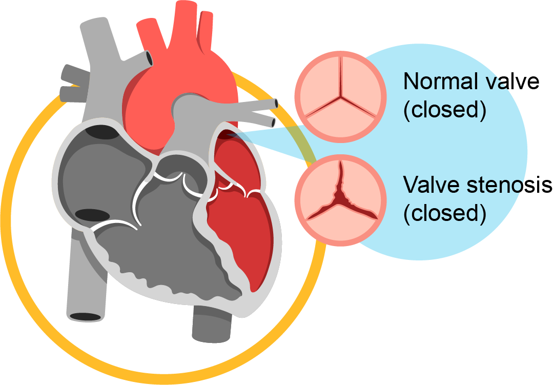 valvular_heart_disease_infobanner_1